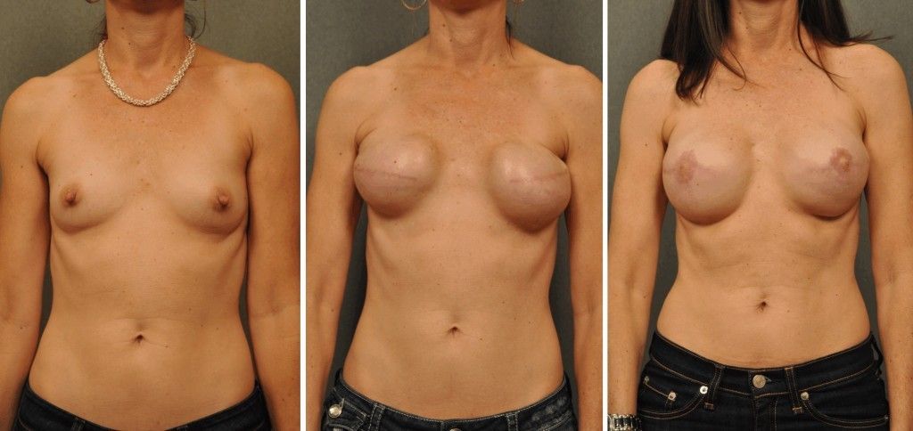 before and after breast reconstruction