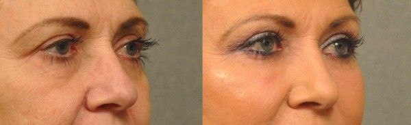 Eyelid Surgery