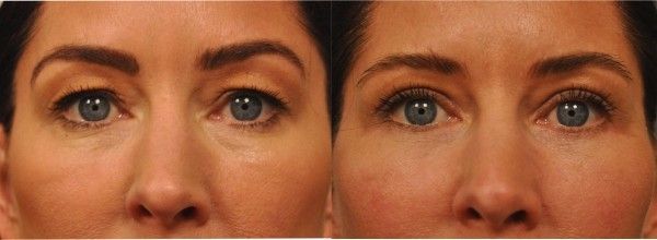 Eyelid Surgery