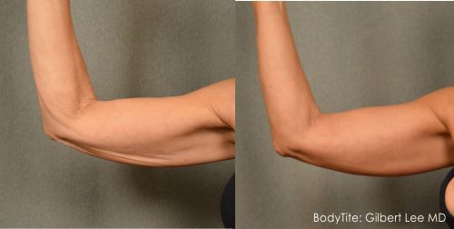 Scarless Arm lift