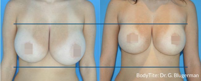 Scarless Breast lift