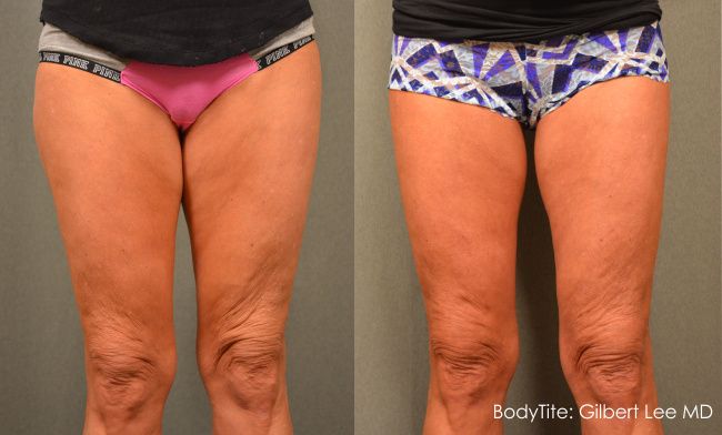 before and after scarless thigh lift