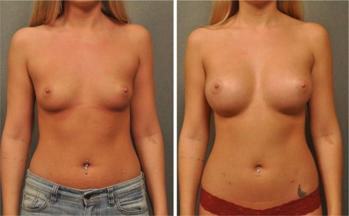 before and after breast augmentation