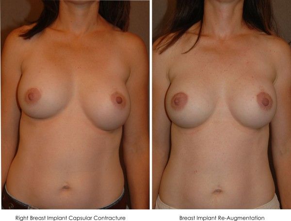 Breast Revision