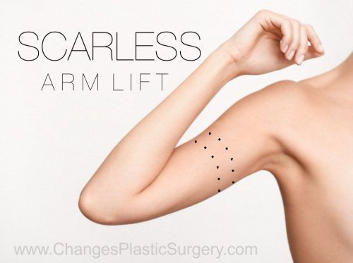 Scarless Arm lift