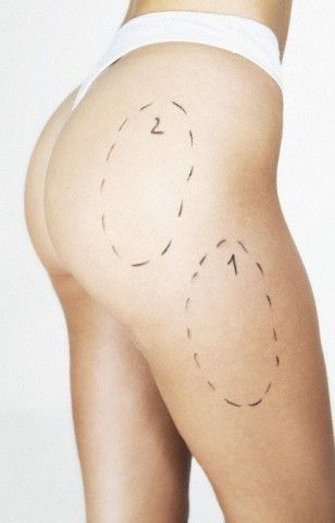 butt and thigh liposuction