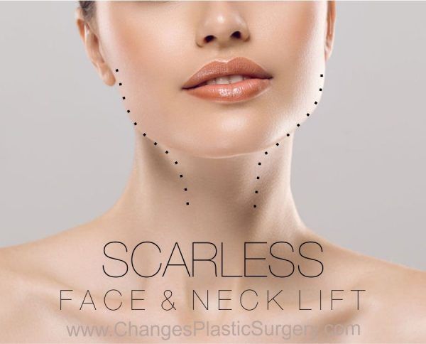 Incisionless Facelift And Necklift