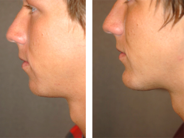 chin implant