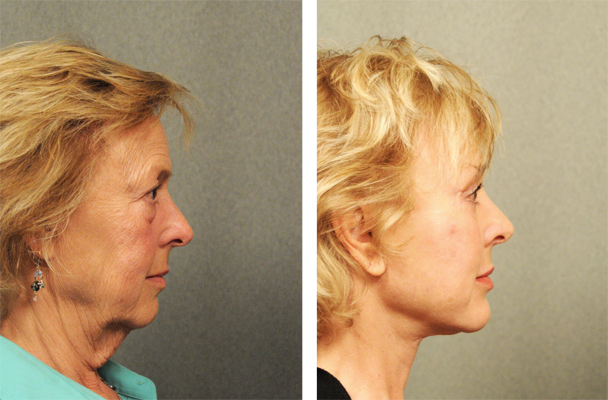 before and after facelift